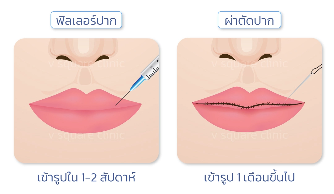 ฉีดฟิลเลอร์ปาก VS ผ่าตัดศัลยกรรมปาก ต่างกันอย่างไร