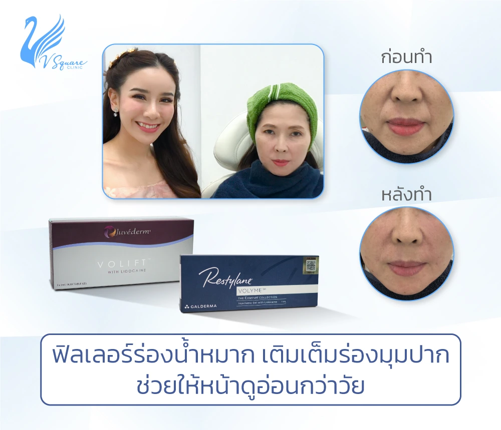 ฉีดฟิลเลอร์ร่องน้ำหมาก
