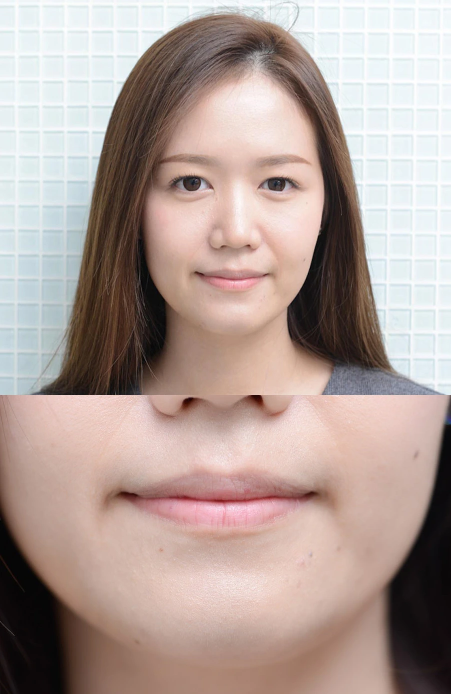 ปัญหาร่องแก้มก่อนฉีดฟิลเลอร์
