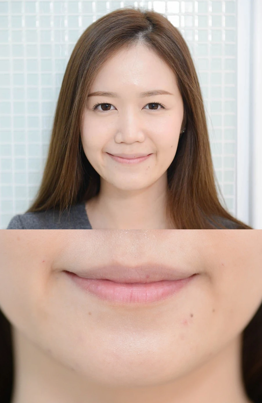 ผลลัพธ์หลังฉีดฟิลเลอร์ร่องแก้ม