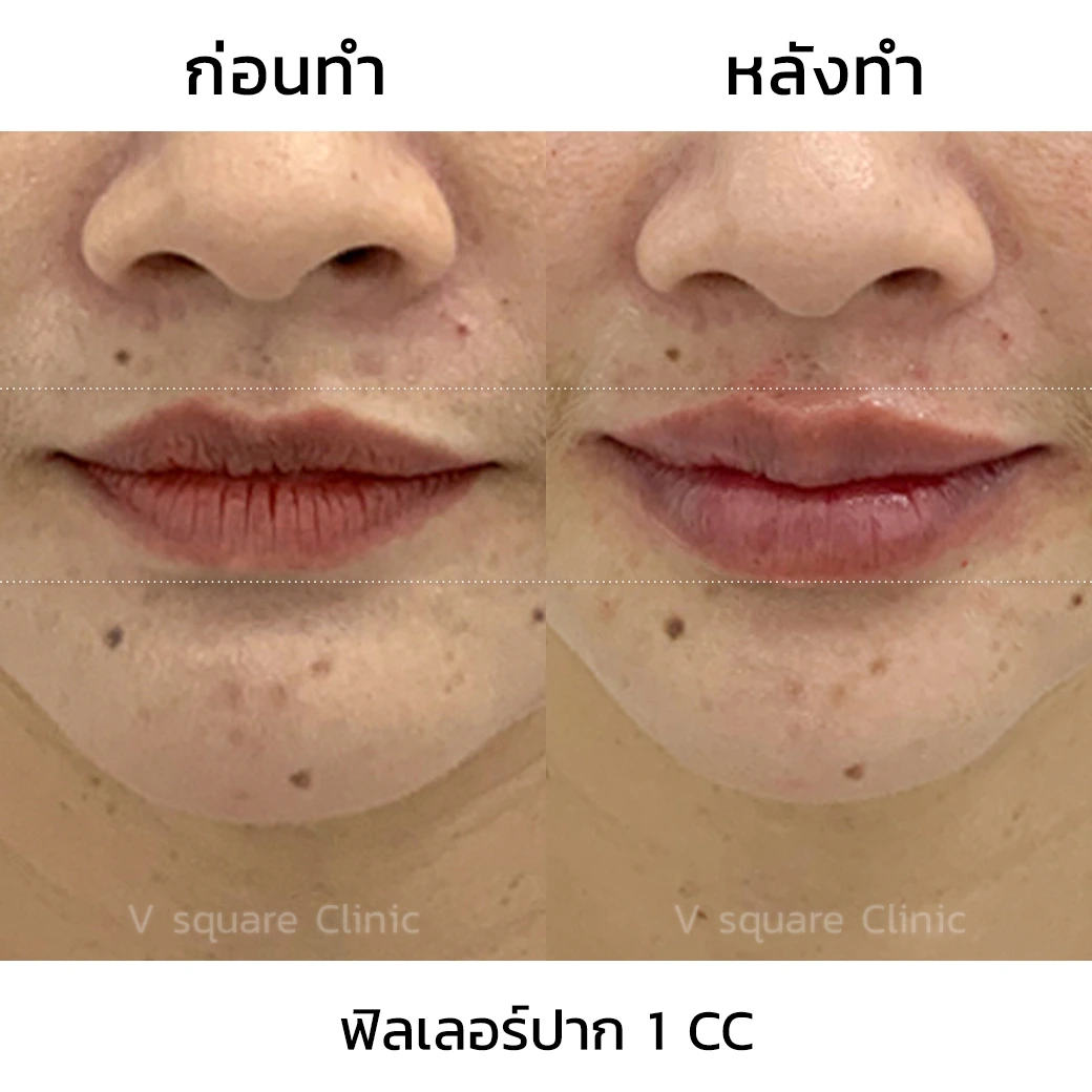 ฟิลเลอร์ปาก 1 cc