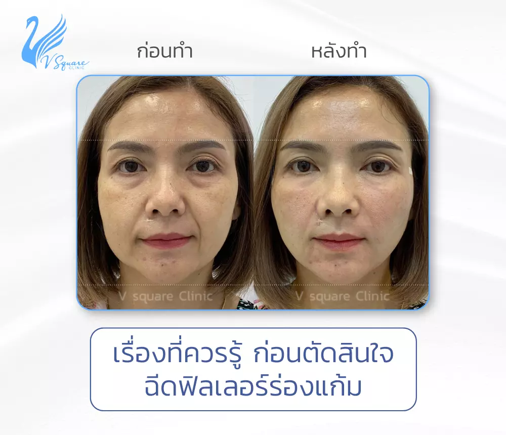 ฟิลเลอร์ร่องแก้ม