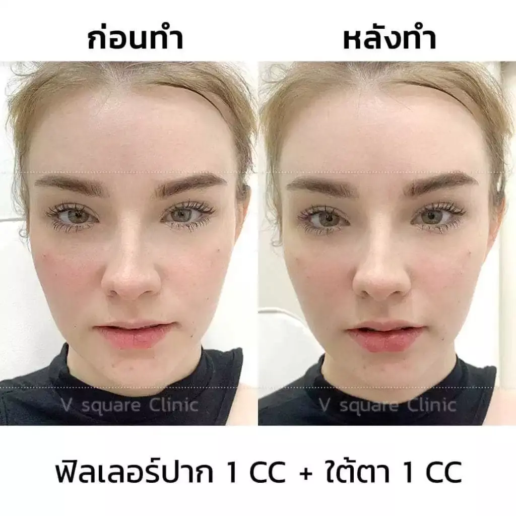 รีวิว ฉีดฟิลเลอร์ปาก 1 CC เจสซี่