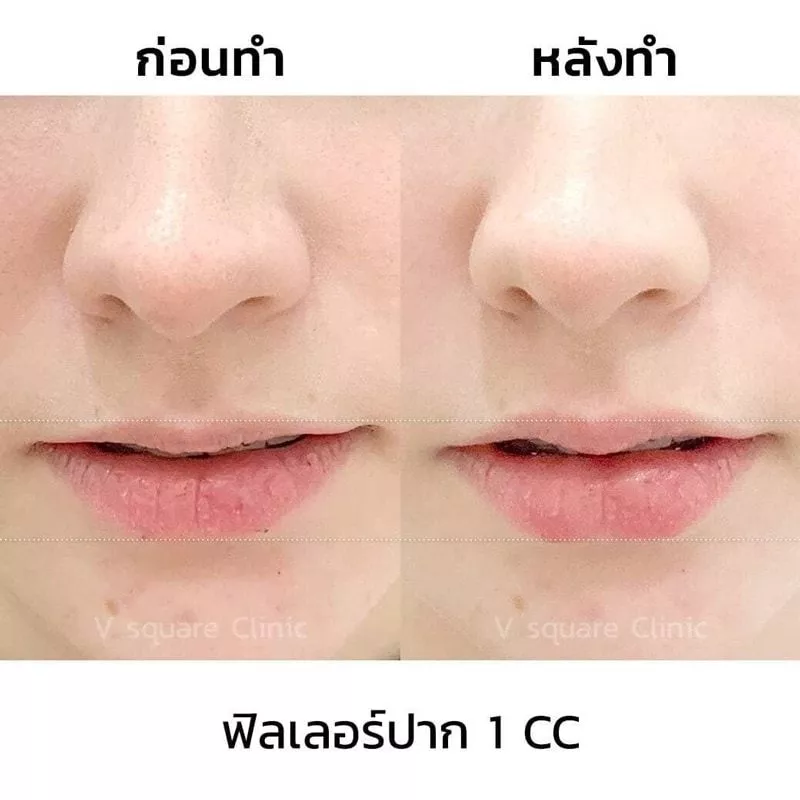 รีวิว ฉีดฟิลเลอร์ปาก 1 CC