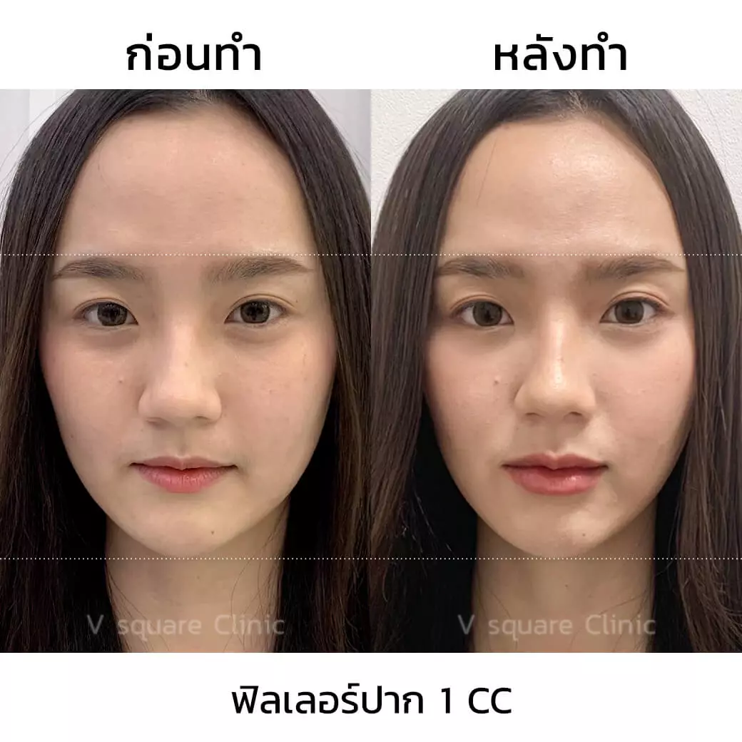 รีวิว ฉีดฟิลเลอร์ปาก 1 CC