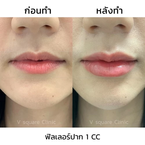 รีวิว ฉีดฟิลเลอร์ปาก 1 CC