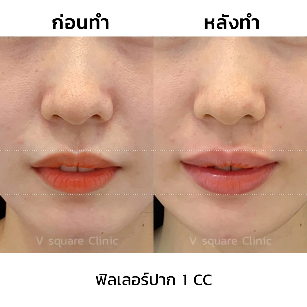 รีวิว ฉีดฟิลเลอร์ปาก 1 CC