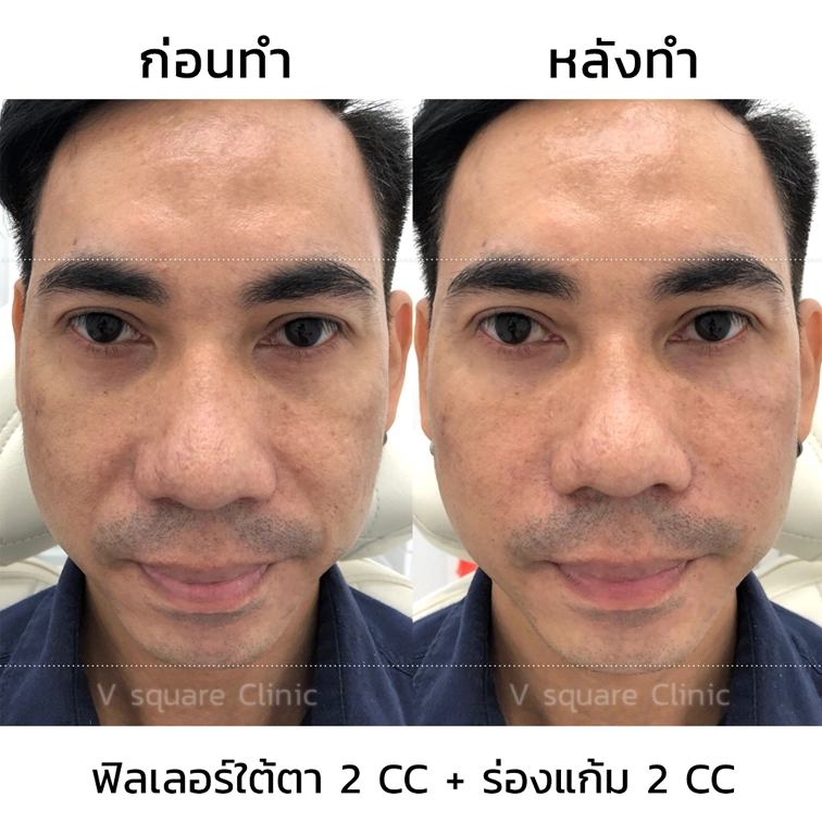 รีวิว ฟิลเลอร์ใต้ตา 2CC+ร่องแก้ม 2 CC (1)