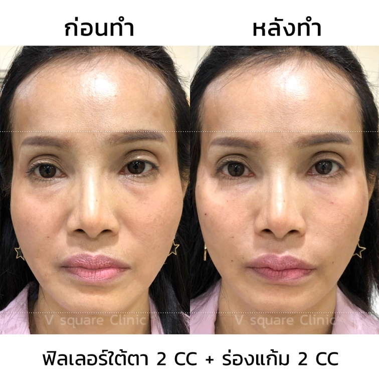 รีวิว ฟิลเลอร์ใต้ตา 2CC+ร่องแก้ม 2 CC (2)