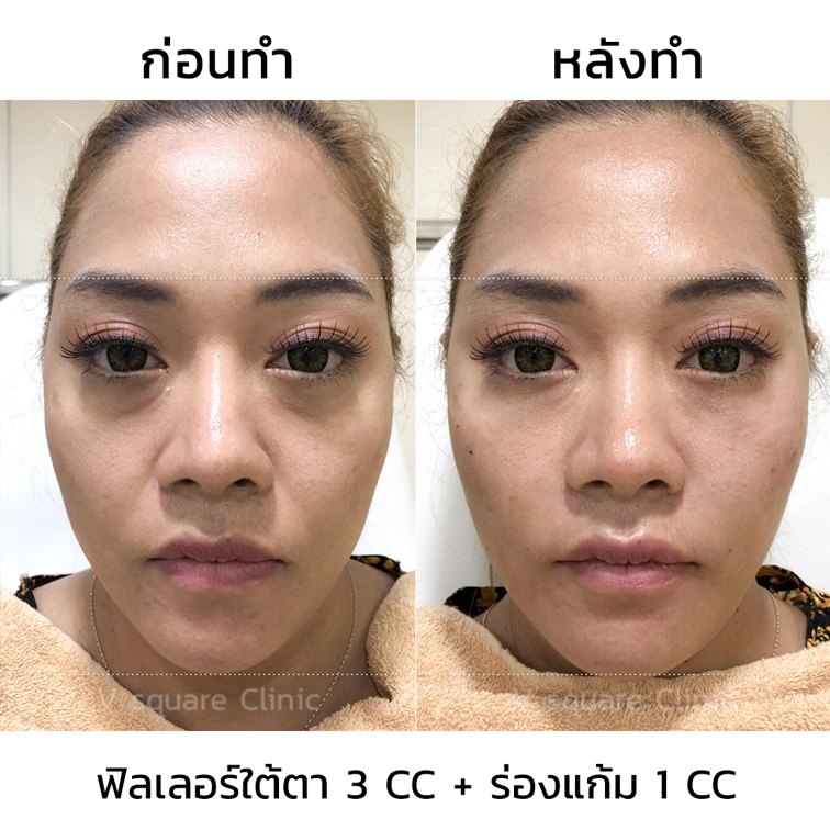 รีวิว ฟิลเลอร์ใต้ตา 3CC+ร่องแก้ม 1 CC