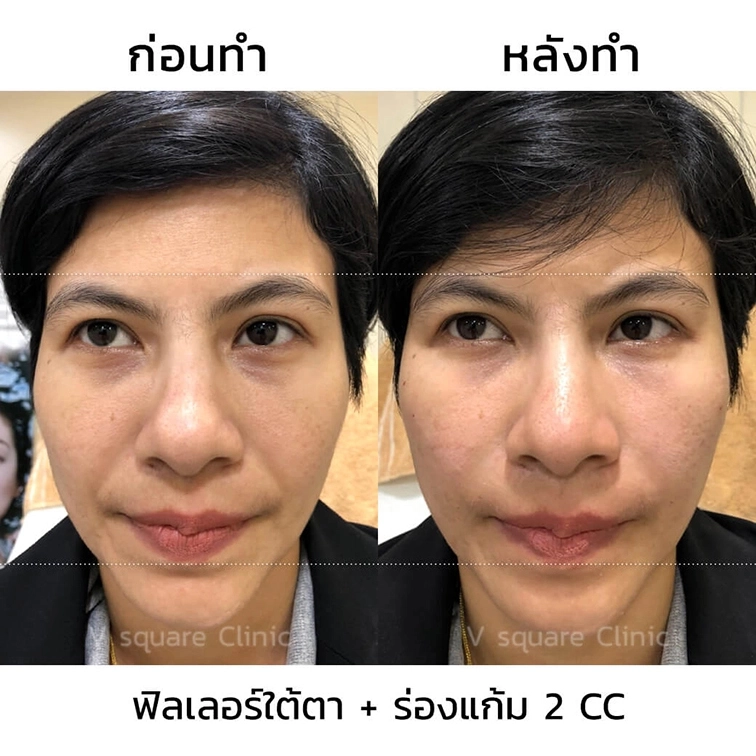 รีวิว ฟิลเลอร์ใต้ตา+ร่องแก้ม 2 CC