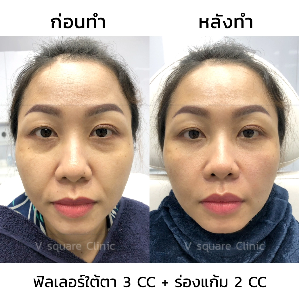 รีวิวฉีดฟิลเลอร์ใต้ตา3 CC+ ร่องแก้ม 2 CC