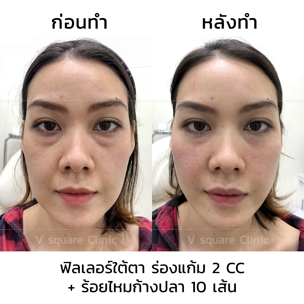 รีวิวฉีดฟิลเลอร์ใต้ตา+ร่องแก้ม 2 CC+ ร้อยไหม 10 เส้น