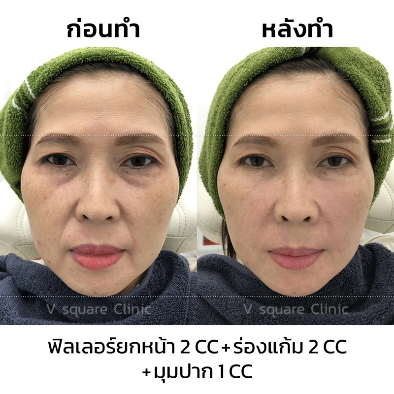 รีวิวฟิลเลอร์มุมปาก 1cc