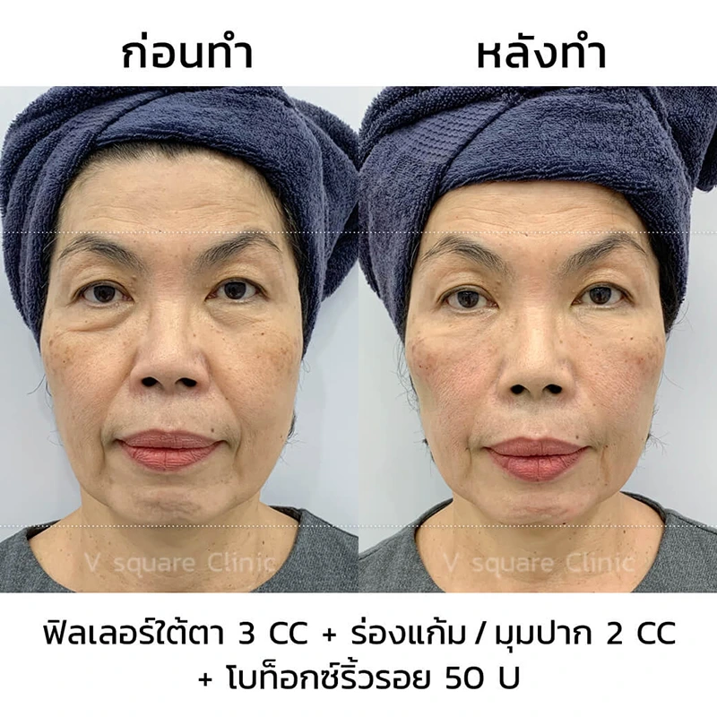 รีวิวฟิลเลอร์มุมปาก 2cc
