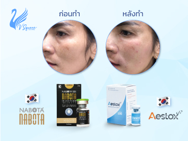 โบท็อกซ์ลดหนกแก้ม