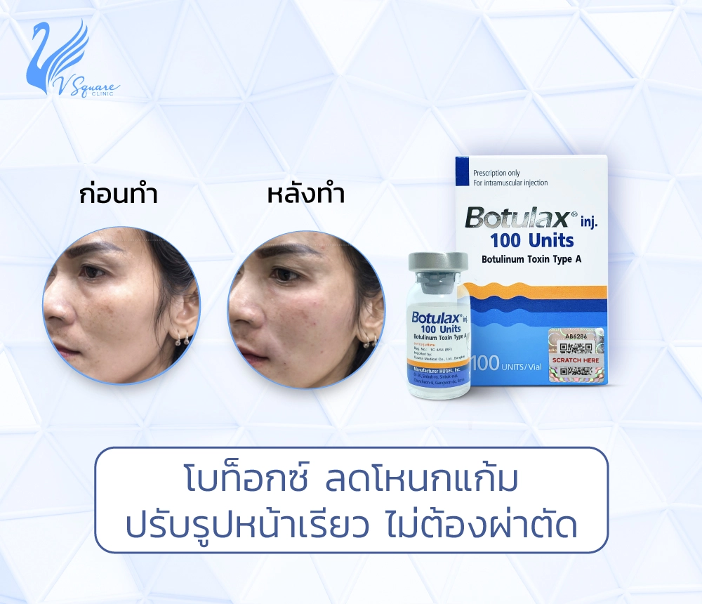 โบท็อกซ์ลดหนกแก้ม