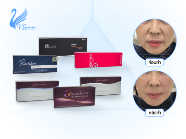 โปรโมชั่นฉีดฟิลเลอร์ร่องแก้ม370x277