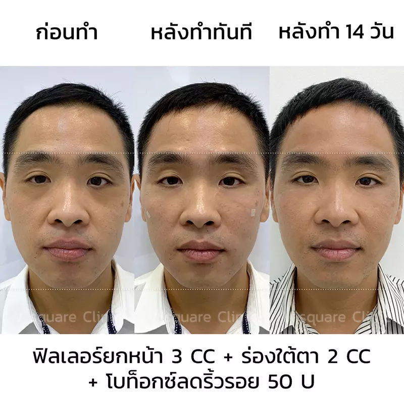รีวิว ฉีดฟิลเลอร์ยกหน้า