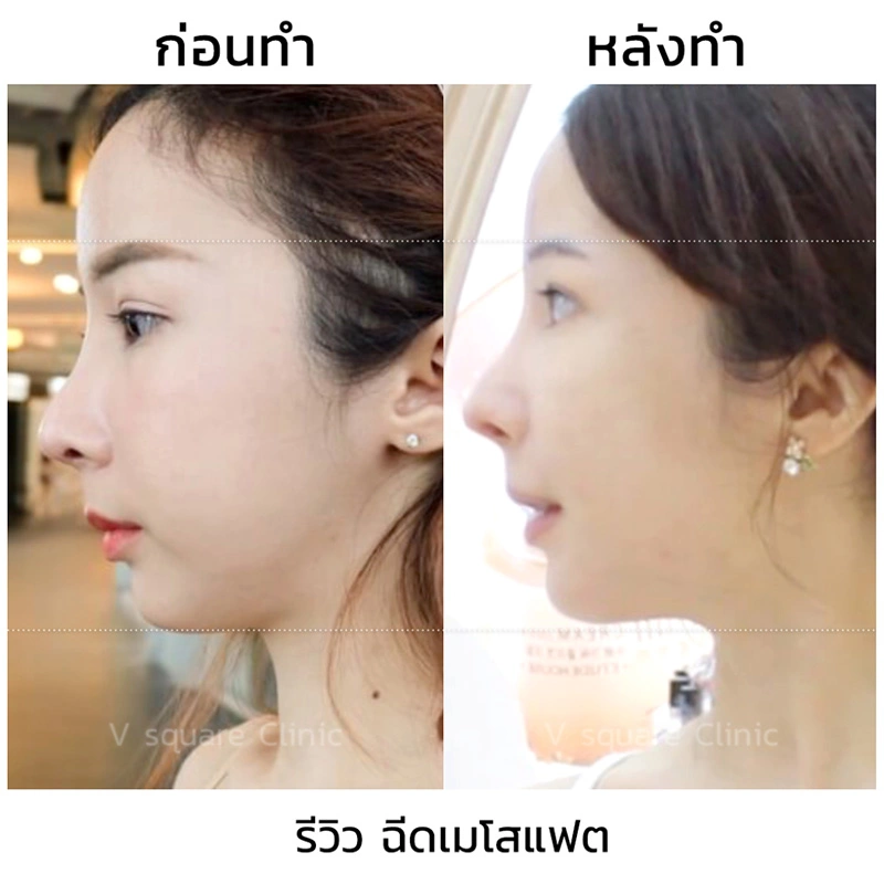 รีวิวฉีดเมโสแฟตลดแก้ม