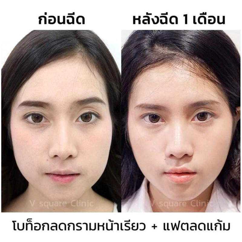 รีวิวฉีดเมโสแฟตลดแก้ม+โบท็อก