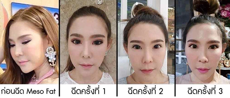 รีวิวฉีดเมโสแฟตหน้าเรียว