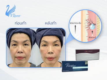 ฟิลเลอร์ยกหน้า