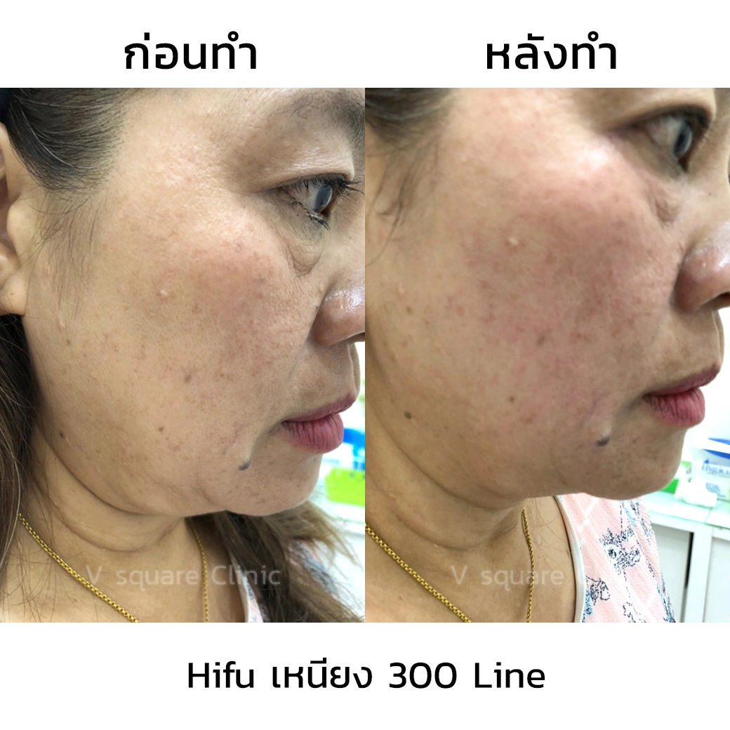 รีวิว Hifu1