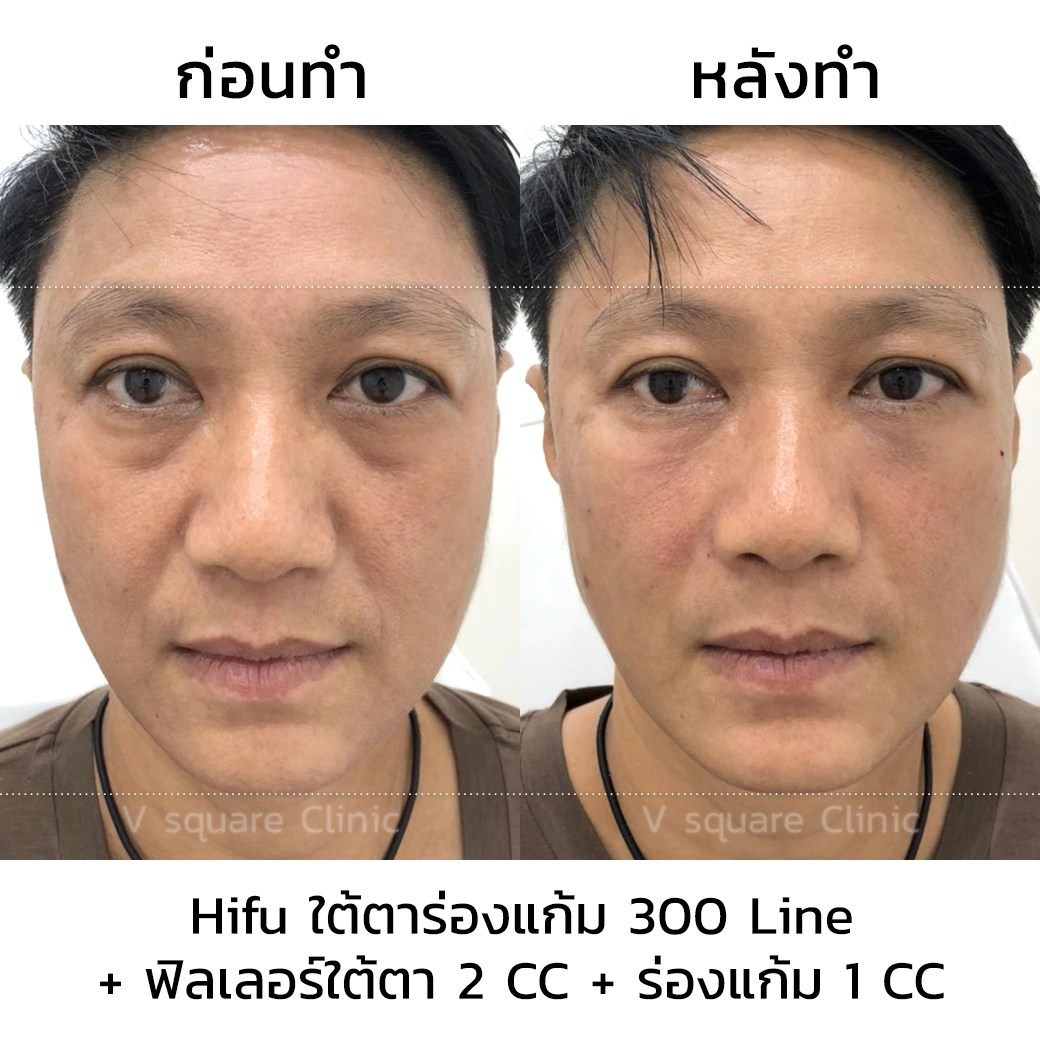 รีวิว Hifu2