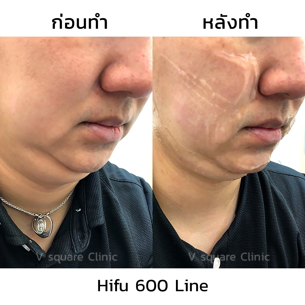 รีวิว Hifu3