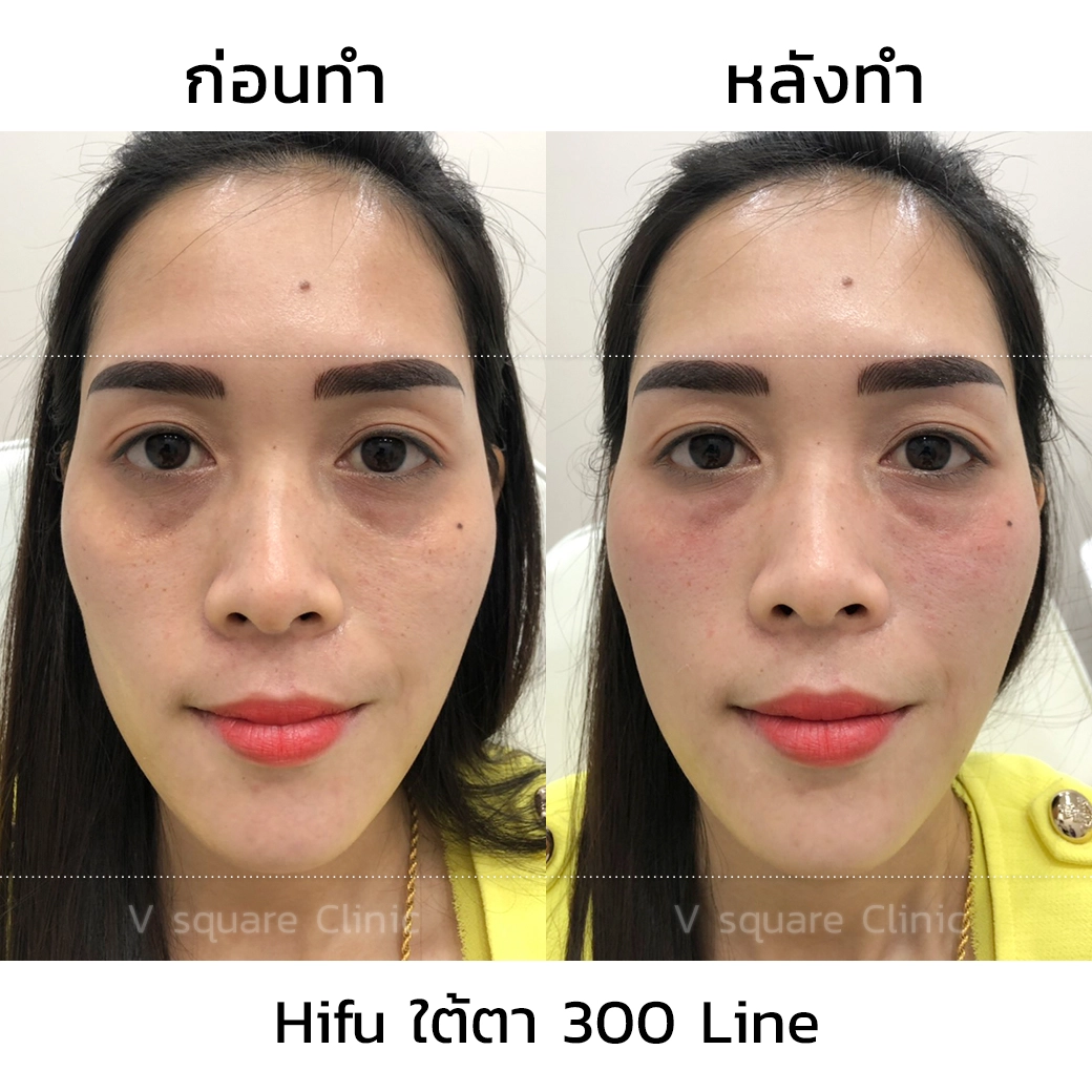 รีวิว Hifu4