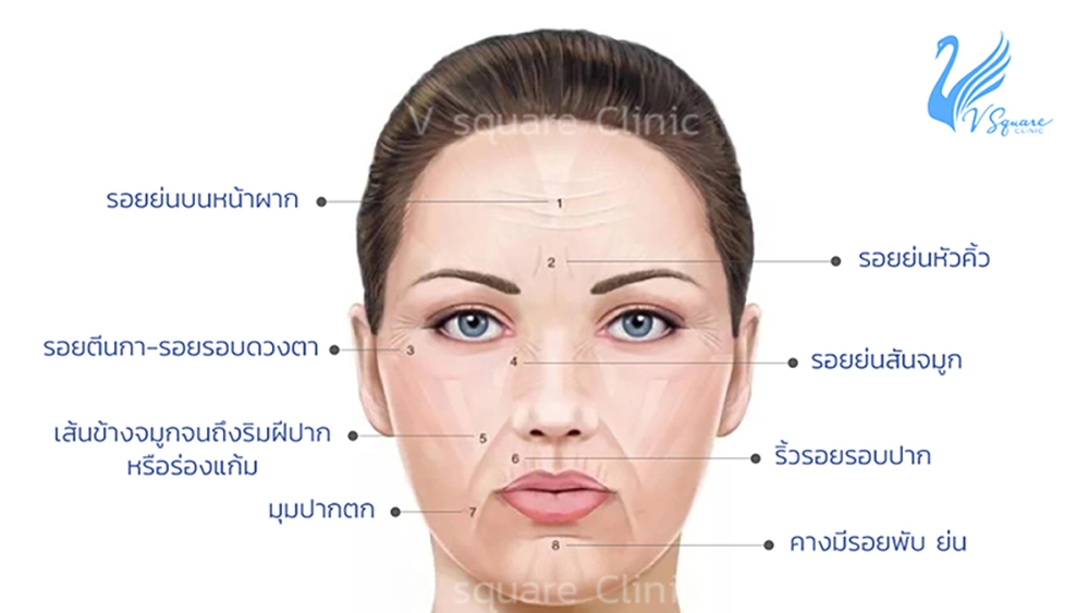 จุดที่นิยมฉีดโบท็อก