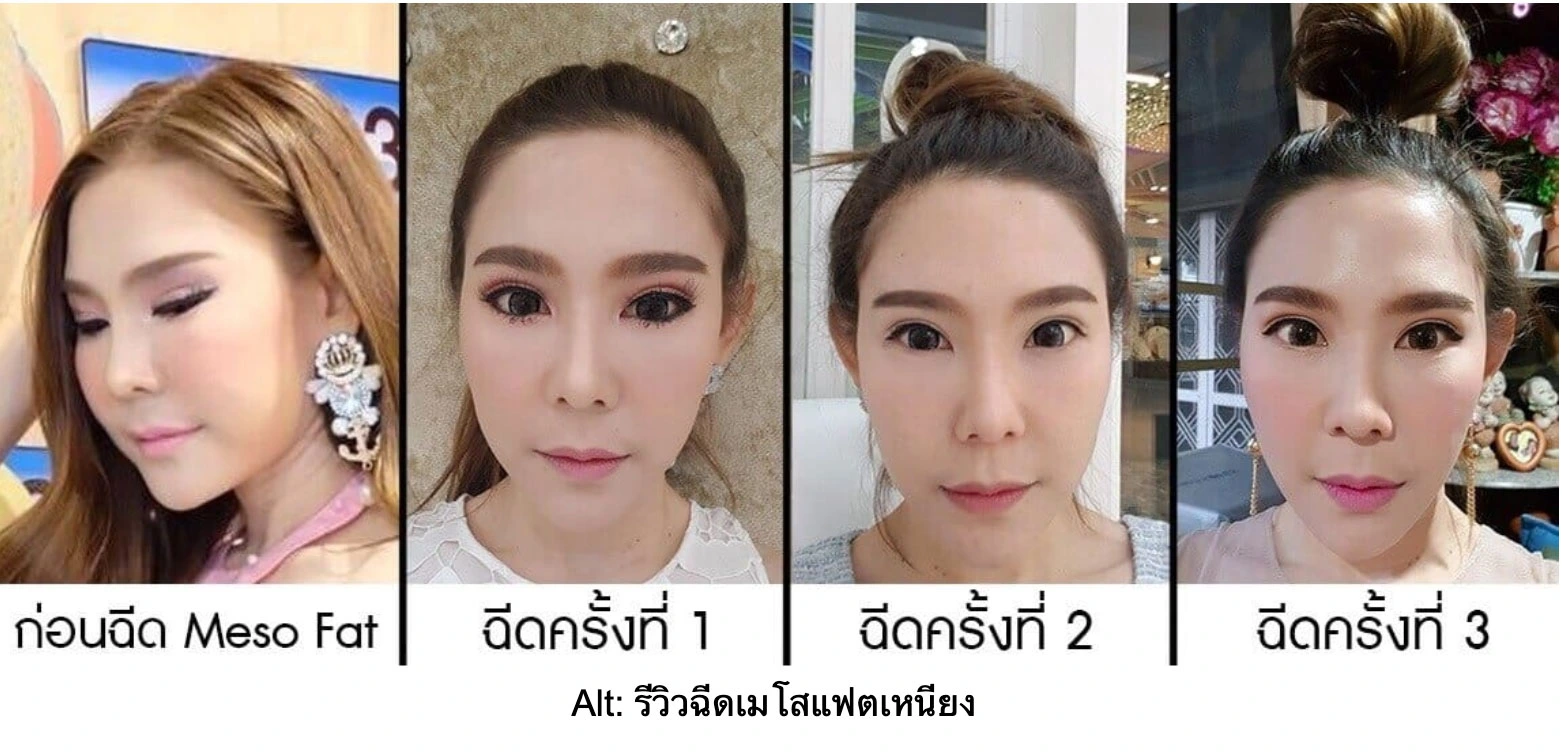 รีวิวฉีดเมโสแฟตเหนียง