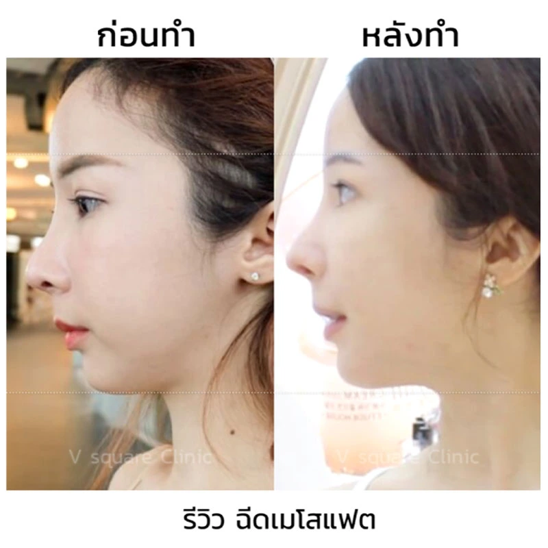 รีวิวฉีดเมโสแฟตเหนียง