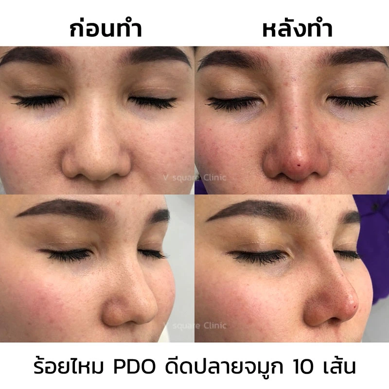 รีวิวร้อยไหมเก็บปีกจมูก ดีดปลายจมูก 10 เส้น