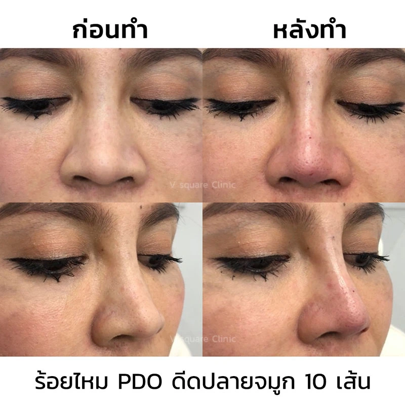 รีวิวร้อยไหมเก็บปีกจมูก ดีดปลายจมูก 10 เส้น
