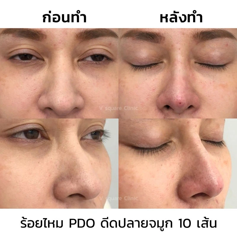 รีวิวร้อยไหมเก็บปีกจมูกปลายจมูก 10 เส้น