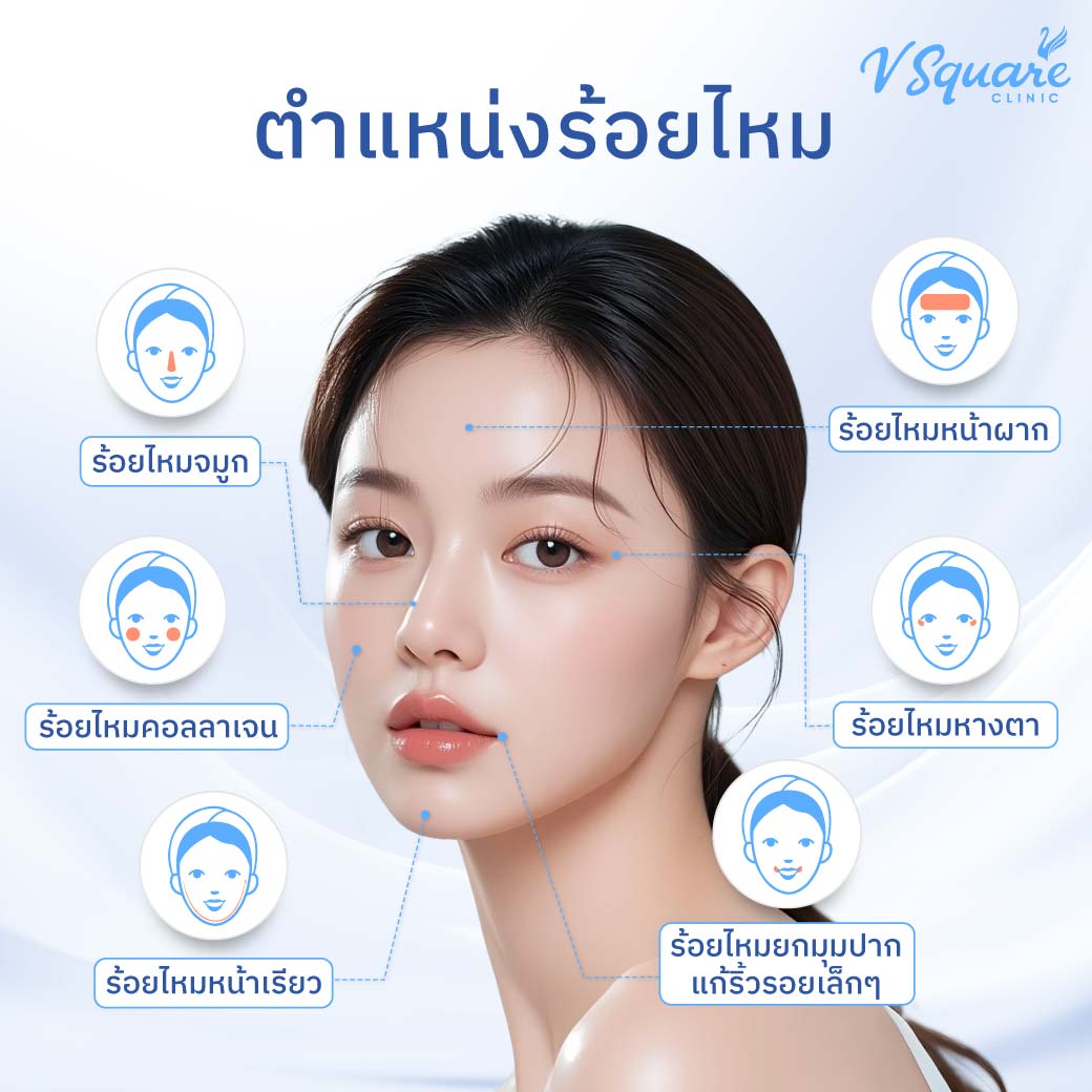 INFO_จุดร้อยไหม
