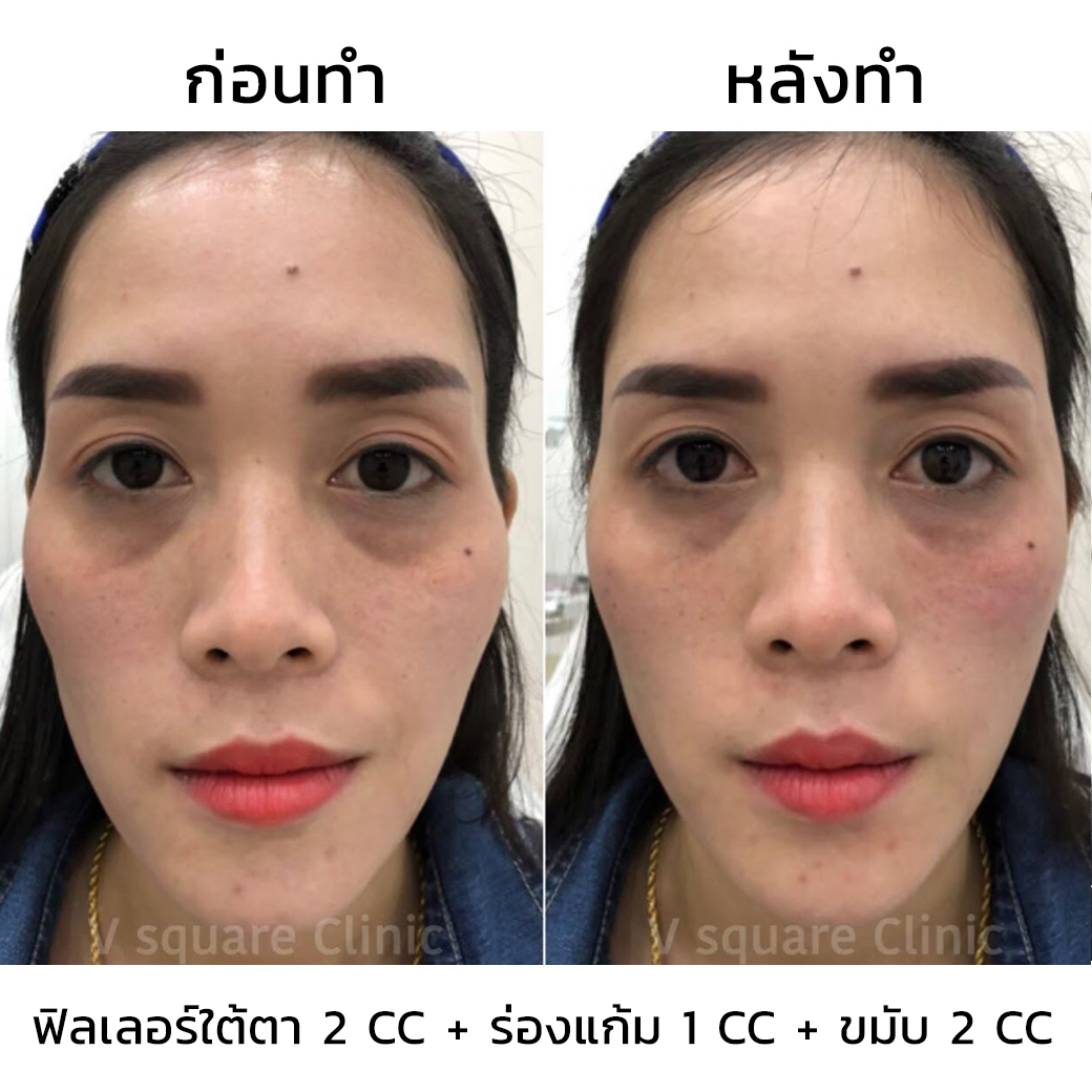 รีวิว ฟิลเลอร์ขมับ_1
