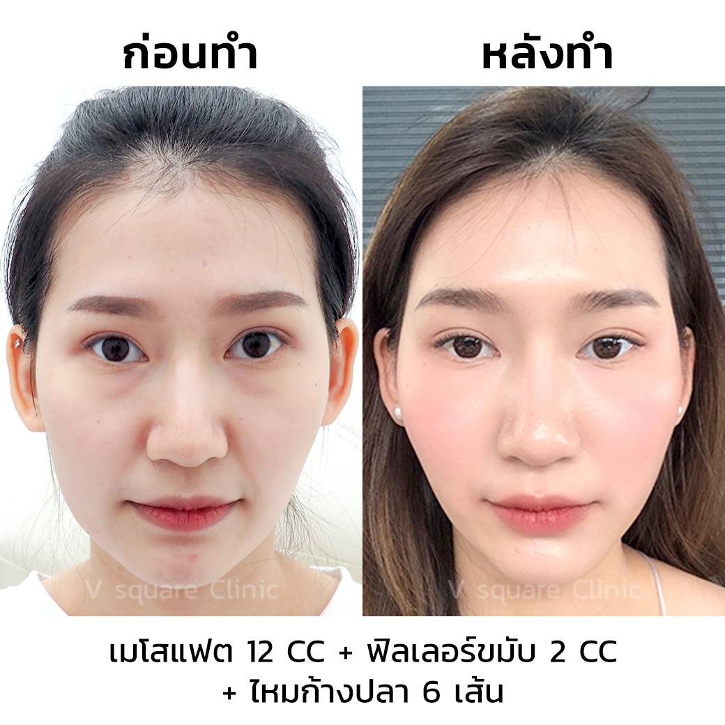 รีวิว ฟิลเลอร์ขมับ_2
