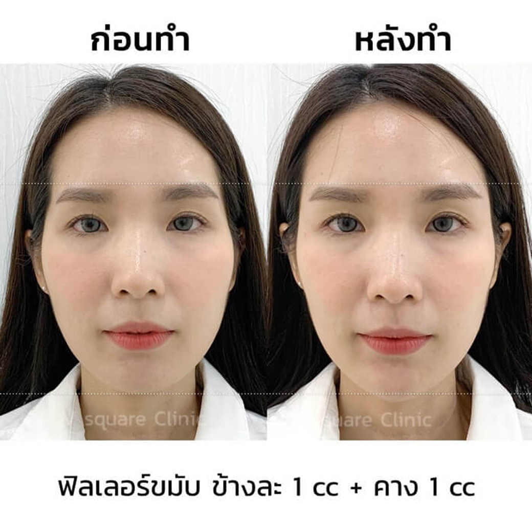 รีวิว ฟิลเลอร์ขมับ_3