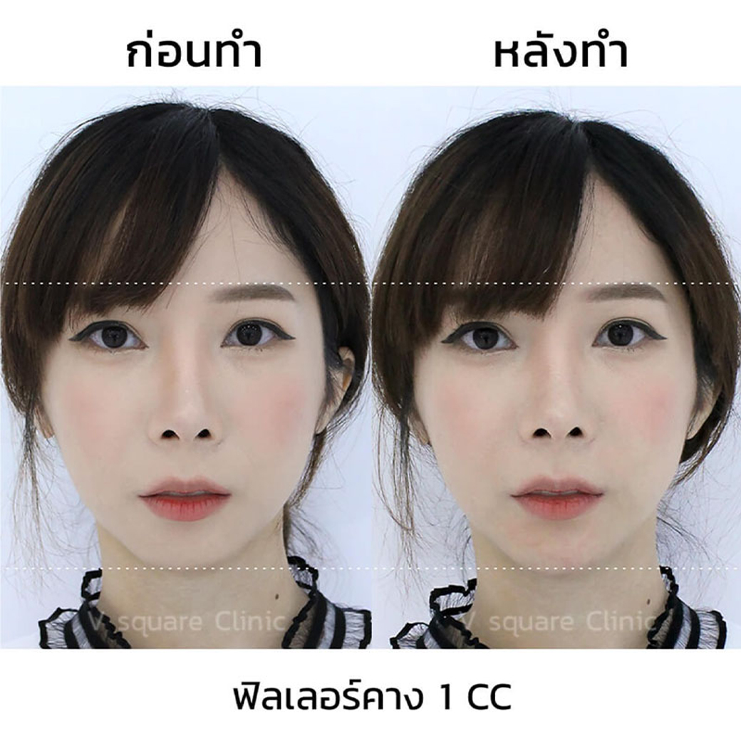 รีวิว ฟิลเลอร์คาง_1