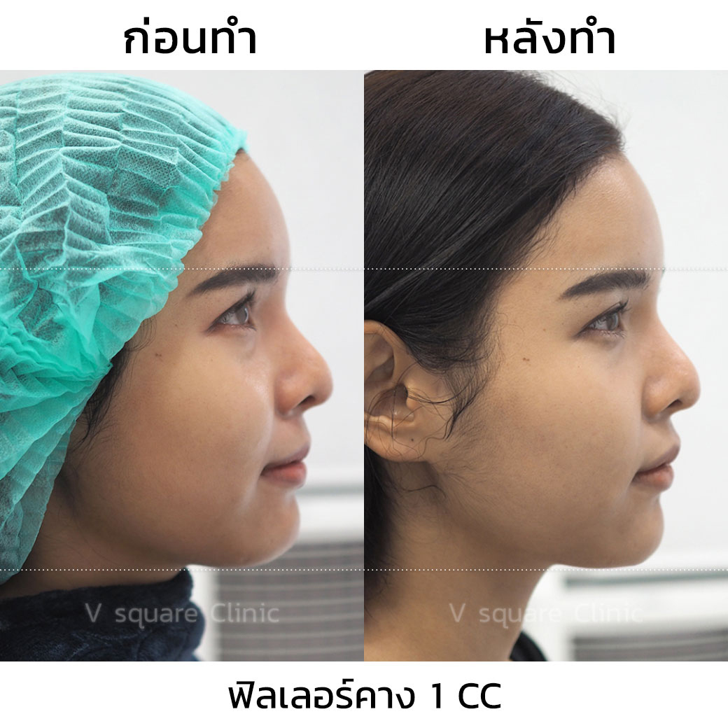 รีวิว ฟิลเลอร์คาง_2
