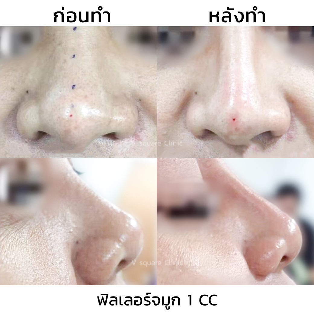 รีวิว ฟิลเลอร์จมูก_1