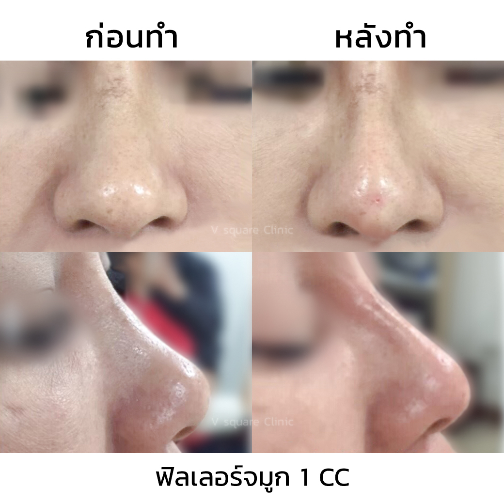 รีวิว ฟิลเลอร์จมูก_2