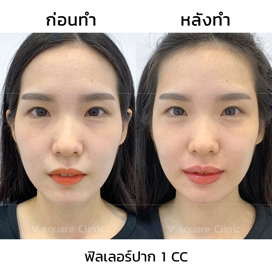 รีวิว ฟิลเลอร์ปาก_1
