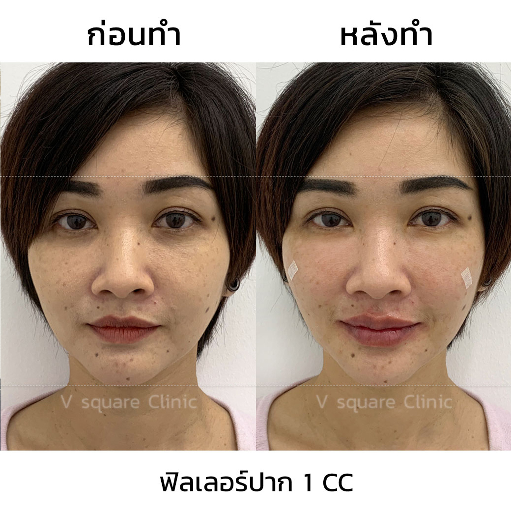 รีวิว ฟิลเลอร์ปาก_3