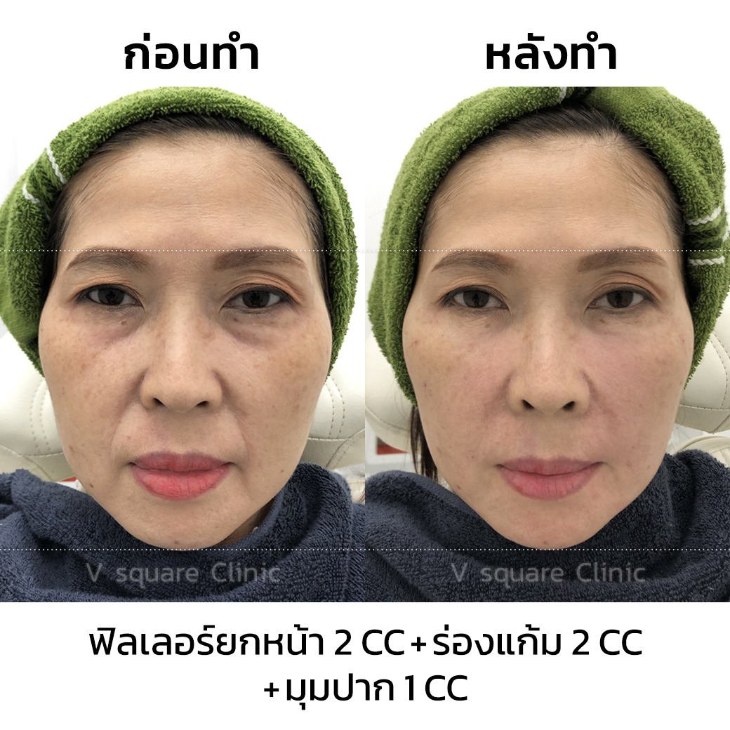 รีวิว ฟิลเลอร์ยกมุมปาก_2