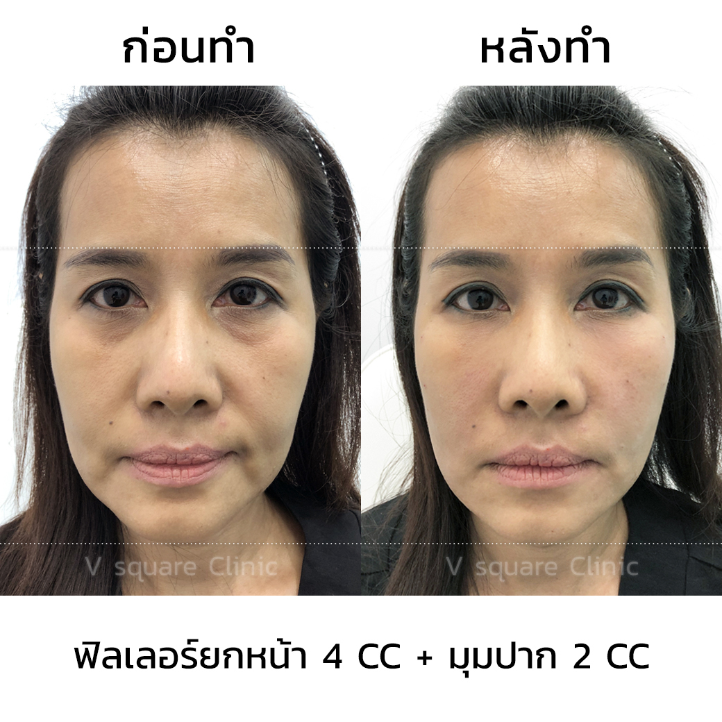 รีวิว ฟิลเลอร์ยกมุมปาก_3