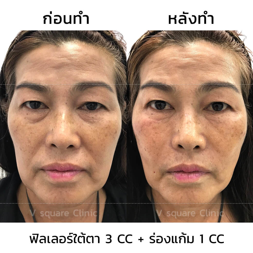 รีวิว ฟิลเลอร์ร่องแก้ม_1